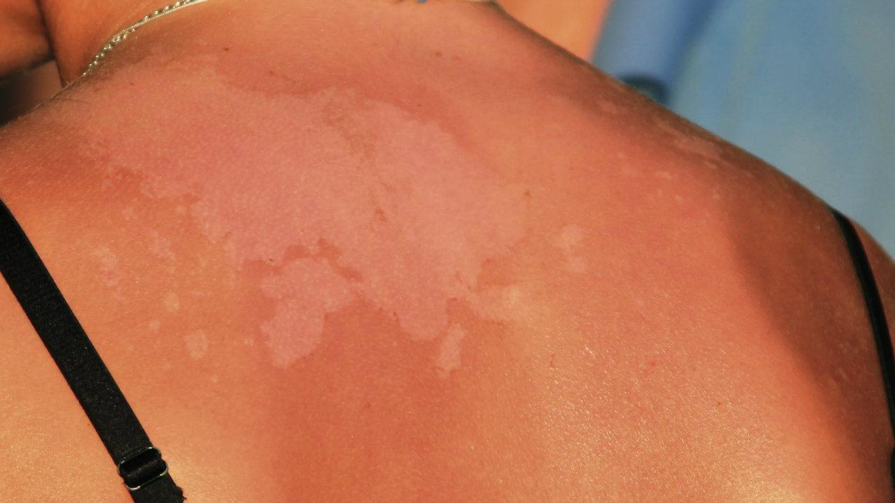 Sunburn from tanning bed How to Treat & Prevent from it